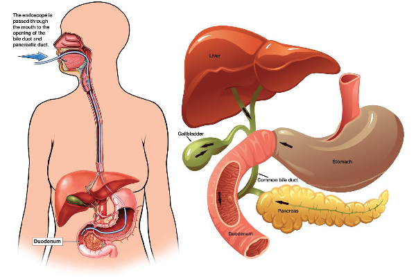 ERCP