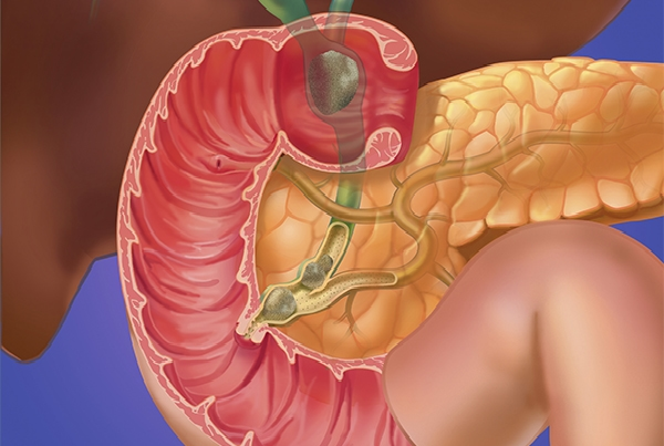 Pancreatic Biliary Disorders