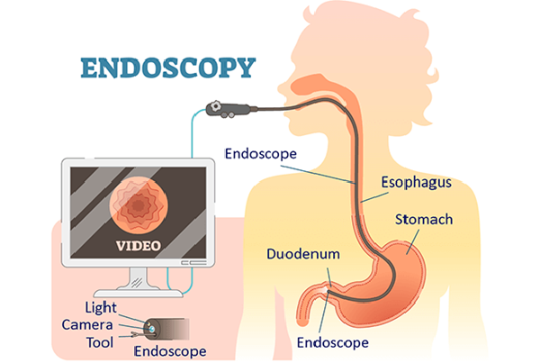 Diagnostic and Therapeutic GI Endoscopic Intervention