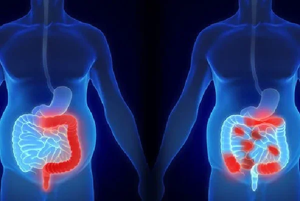Inflammatory bowel diseases