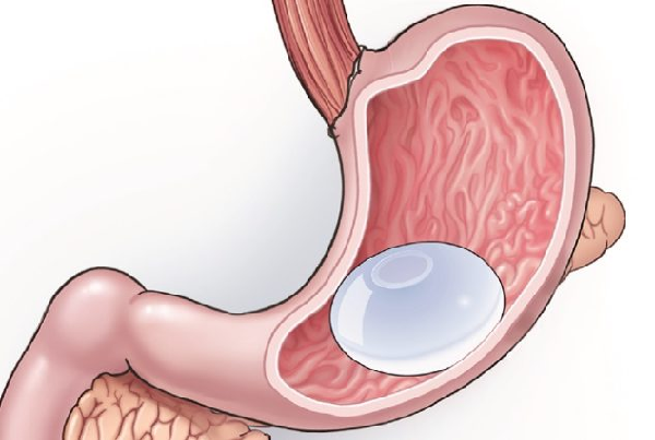 Endoscopic Treatment of Obesity