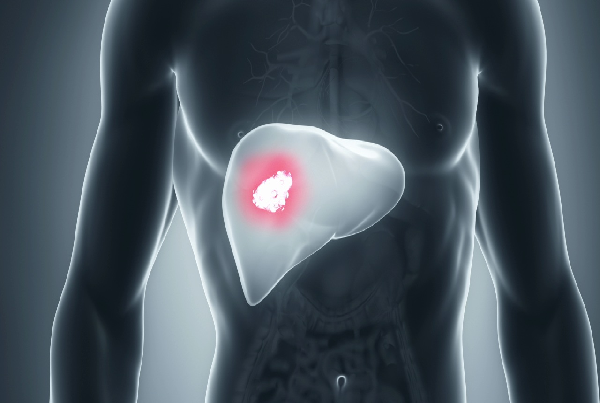 Early GI/Cancers Hepatic